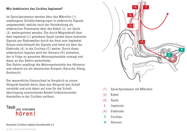 Wie funktioniert das Hören mit einem Cochlea Implantat?